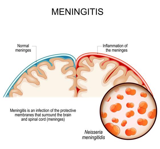 Getty_meningitis_meningite_Neisseria meningitidis_2026.jpg